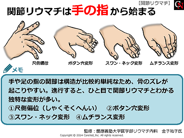 手の指の変形のイメージ